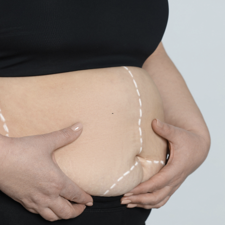 How Much Does Liposuction Cost in Arlington Virginia